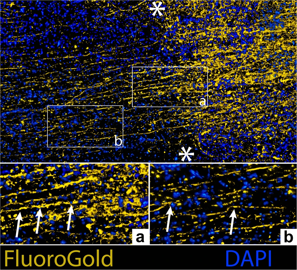 FluoroGold tracing in yellow and DAPI-stained nuclei in blue, with enlarged regions on either side of the lesion.
